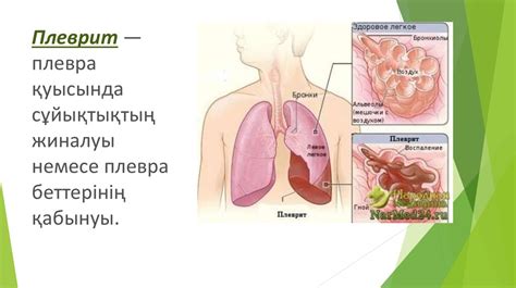Плеврит - презентация онлайн