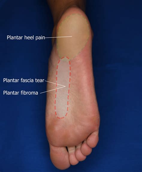 Plantar Fascia Tear