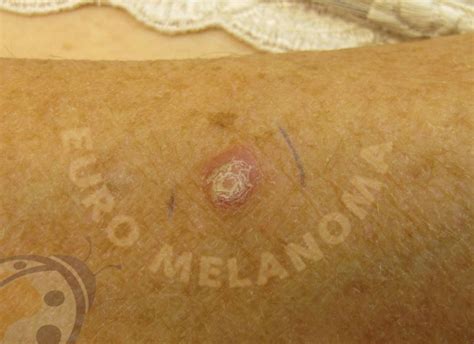 Types of skin cancer - Spinaliom - Euromelanoma