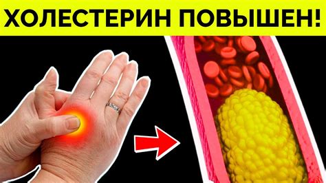 Вот как обнаружить ВЫСОКИЙ ХОЛЕСТЕРИН! Методы снижения ХОЛЕСТЕРИНА ...