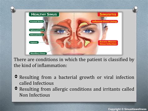 PPT - Sinusitis Disease: Symptoms & Precautions PowerPoint Presentation
