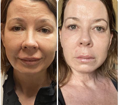 Cog Thread Lifts: A Customizable Lift with Expert Precision - New Look