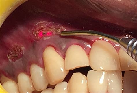 Laser Mouth Ulcer Treatment – Moses