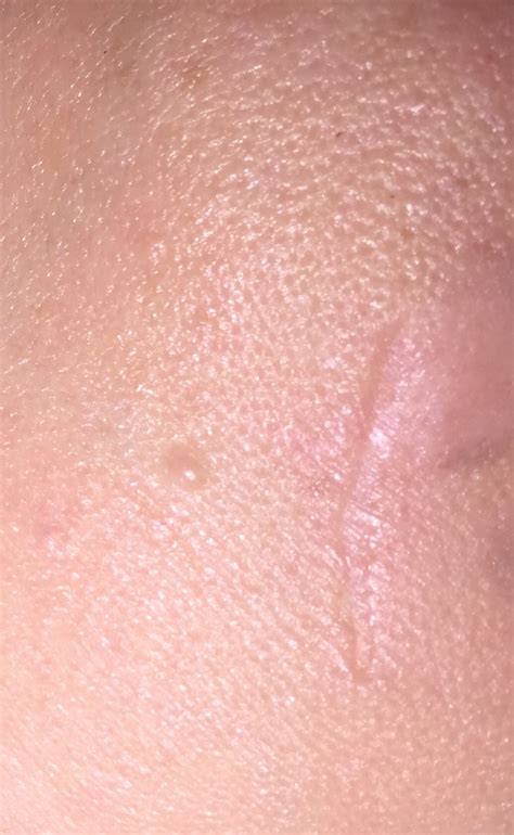 scar excisionrevision left indented scar  excision acne scars