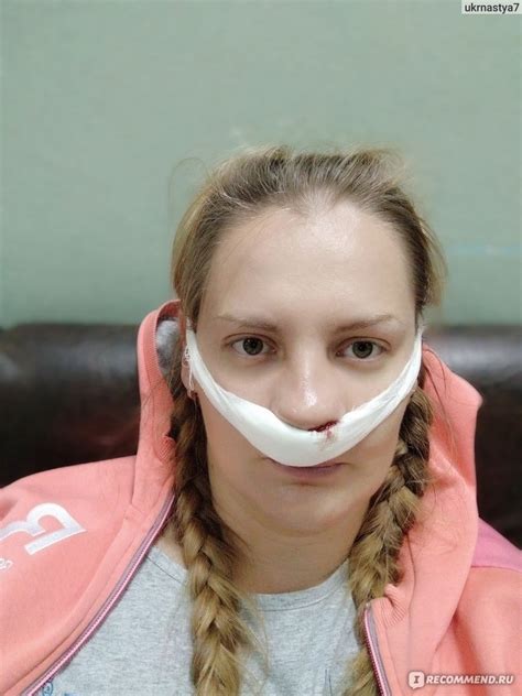 Септопластика - операция по исправлению носовой перегородки - «На это ...