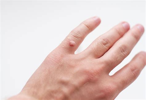 ASK THE DOC: What is the best treatment for warts?