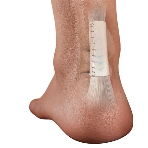 Biologic Scaffold Use in Foot & Ankle Tendon Repairs