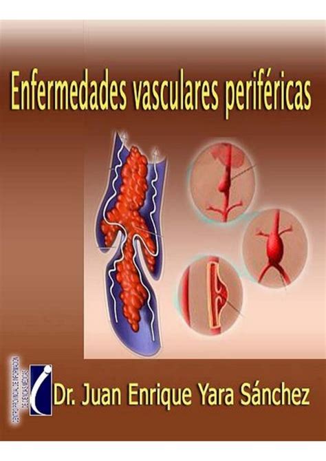 Enfermedades vasculares periféricas