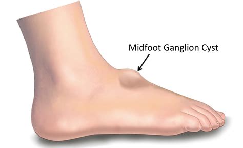 ganglion cyst foot surgery surgical management  ganglion cysts