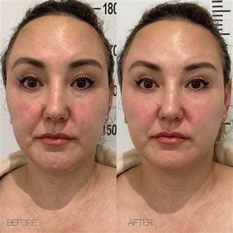 hifu face treatment 7