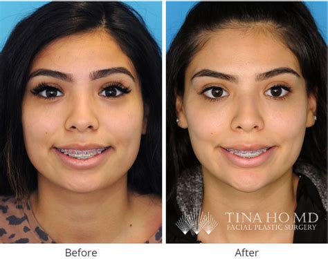 Strong Jawline Surgery at Tracy Jacoby blog