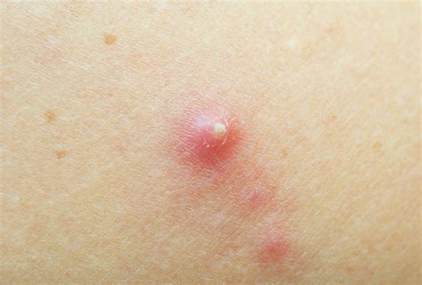 Boils and Abscesses: Symptoms, Treatment, & Complications