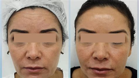 Qual O Valor Do Botox No Rosto - Botox No Rosto Antes E Depois: Conheça Os Benefícios! – FDDC