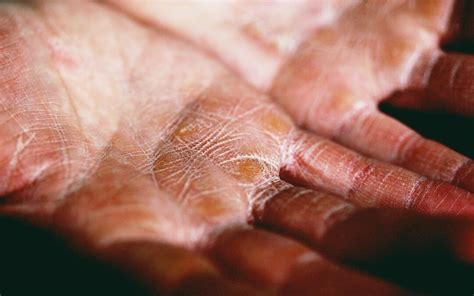 Eczema Herpeticum: Understanding the Symptoms, Causes, and Treatment ...