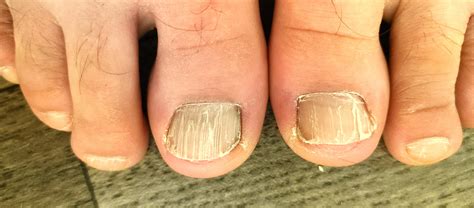 I was born with cracks in my toenails and I just never knew why. they