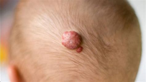 Hemangioma: Symptoms, Diagnosis, and Treatment