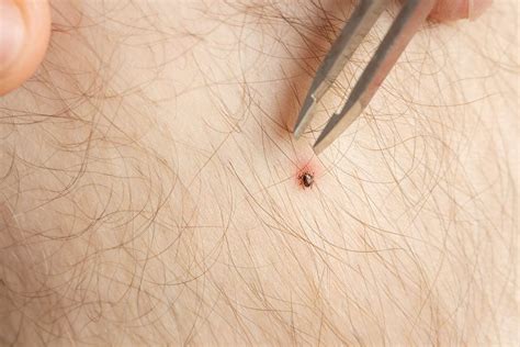 What Does A Tick Bite Look Like Before The Bullseye - Infoupdate.org 