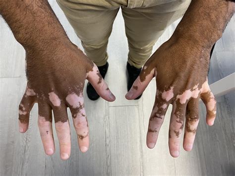 Le vitiligo • Docteur Agathe Aoun