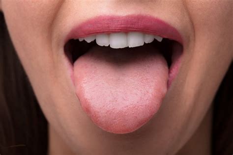 pictures of bumps on the tongue 12