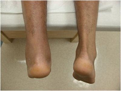 Minimally Invasive Achilles Repair | OrthoVirginia