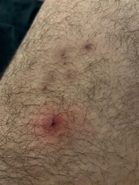Pimples on thigh : r/pimplecommunity