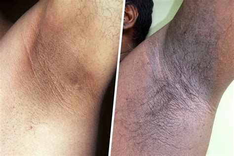 acanthosis nigricans neck  children