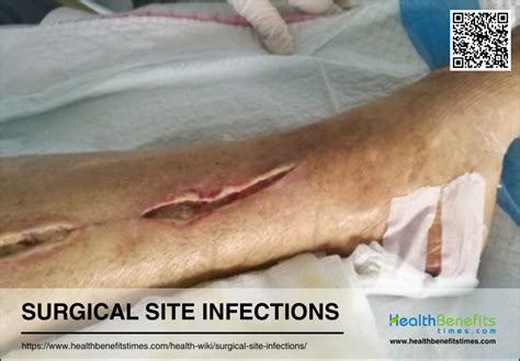 surgical site infections health benefits