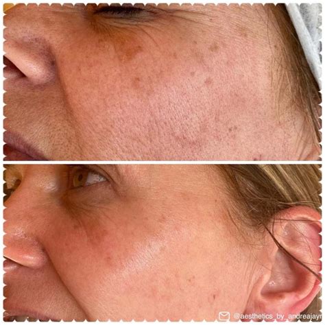 Salicylic Acid Peel: Everything You Need to Know