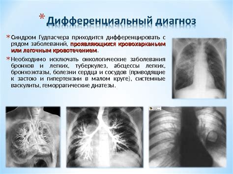 Презентация Синдром Гудпасчера