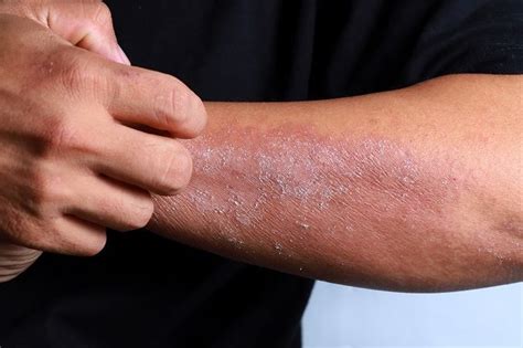 Pellagra - Gejala, Penyebab, dan Pengobatan - Alodokter