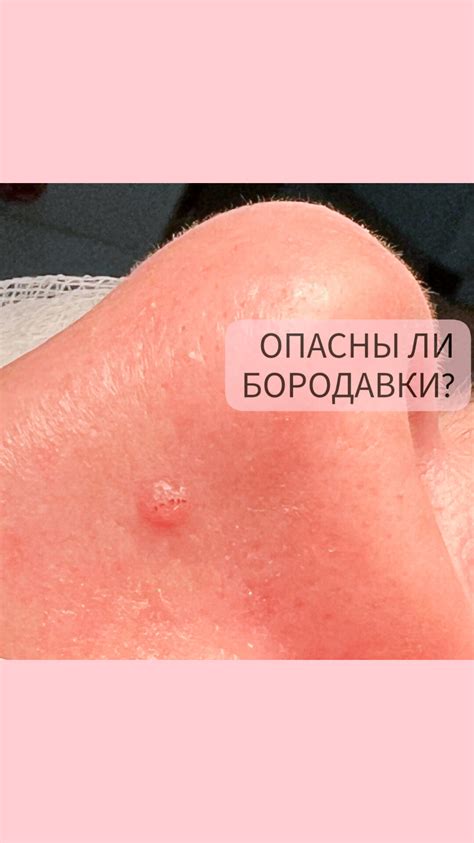 Опасны ли бородавки?