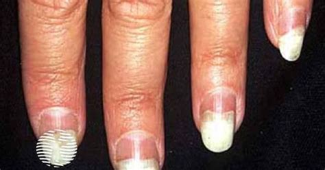 photo onycholysis image