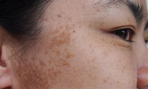 brown spots  san antonio seguin  lavernia tx ross dermatology