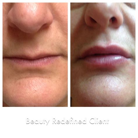 One Syringe Of Lip Filler Results at Anitra Bourne blog