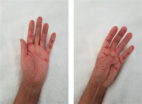 The Functional Kapandji score denotes opposition of the thumb with the ...