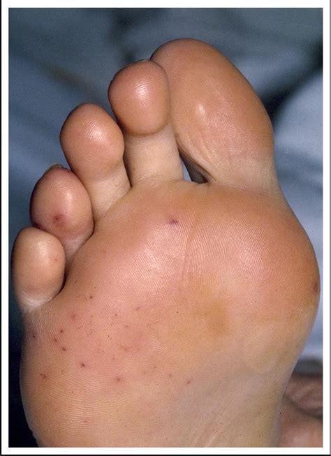 Osler’s Nodes and Janeway Lesions - The American Journal of Medicine