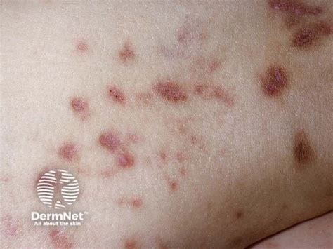 Why Diabetes Can Cause Dark Spots on Your Legs | DiabetesTeam