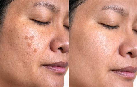 Sunspots On Face Treatment