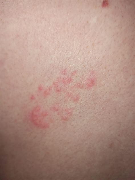 Travel with shingles? : r/shingles