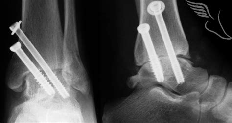 Arthroscopic ankle fusion
