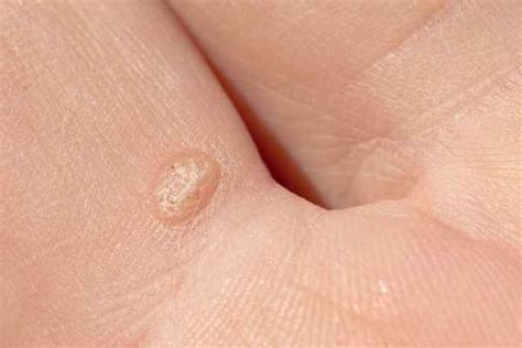 Can you cut off warts with nail clippers
