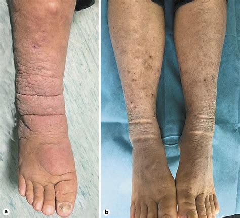Pretibial Myxedema Wiyh Graves Disease 1 - vrogue.co