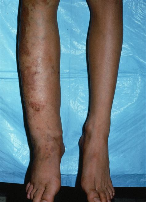 Klippel Trenaunay Syndrome Klippel Trenaunay Syndrome | SpringerLink