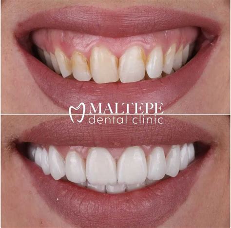 teeth reshaping procedure   expect maltepe dental clinic