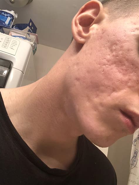 Severe acne scars have ruined my life – Scar treatments – Acne.org Forum