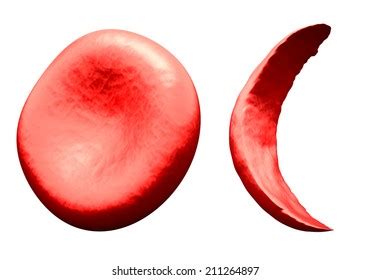 Normal Vs Sickle Red Blood Cell Stock Illustration 211264897 | Shutterstock