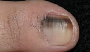 Can I Have Skin Cancers on My Feet? | Watsonia Podiatry