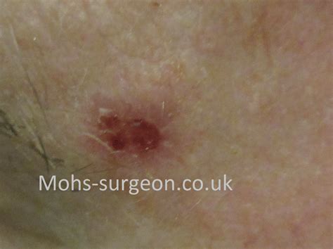 Basal cell carcinoma pictures: BCC on the forehead | Mohs Surgeon