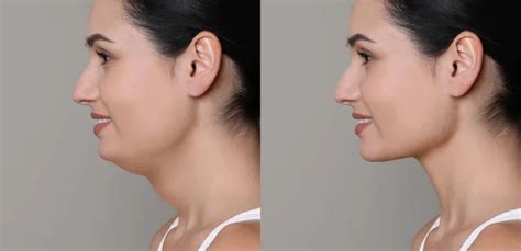 Chin implant Stock Photos, Royalty Free Chin implant Images | Depositphotos