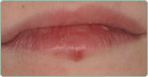 how to know a mouth ulcer is healing